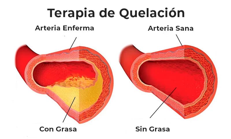 Terapia de quelación: foto 1 — Dra. Eglée Mendoza, Acarigua
